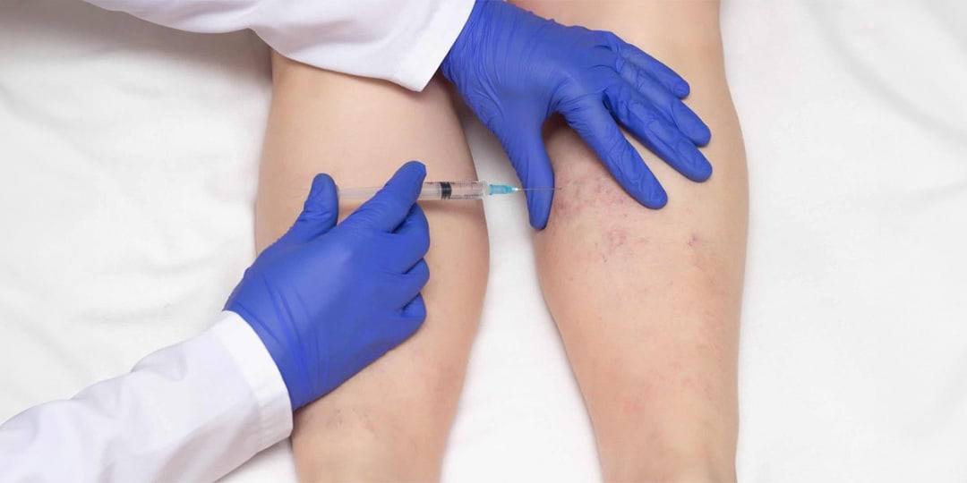 Olympic Vascular Lab and Vein Center spider veins treatment