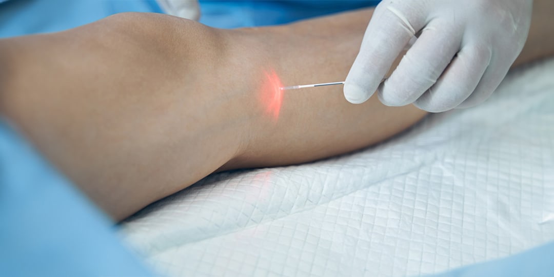 Olympic Vascular Lab and Vein Center varicose veins laser treatment